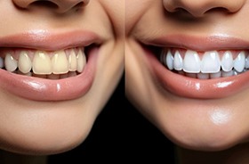 Woman’s smile before and after teeth whitening