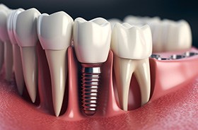 Digital image of dental implant between natural teeth