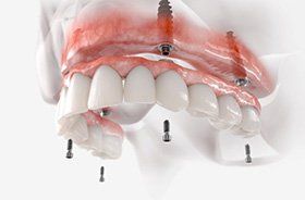 Illustration of implant dentures for upper arch