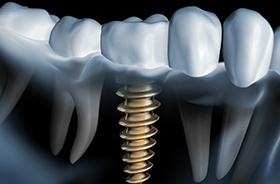X-ray diagram of dental implants in Hamden