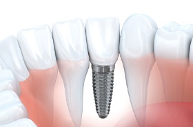 Single dental implant and crown in lower dental arch
