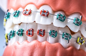 Close-up of dental model with colorful orthodontic brackets